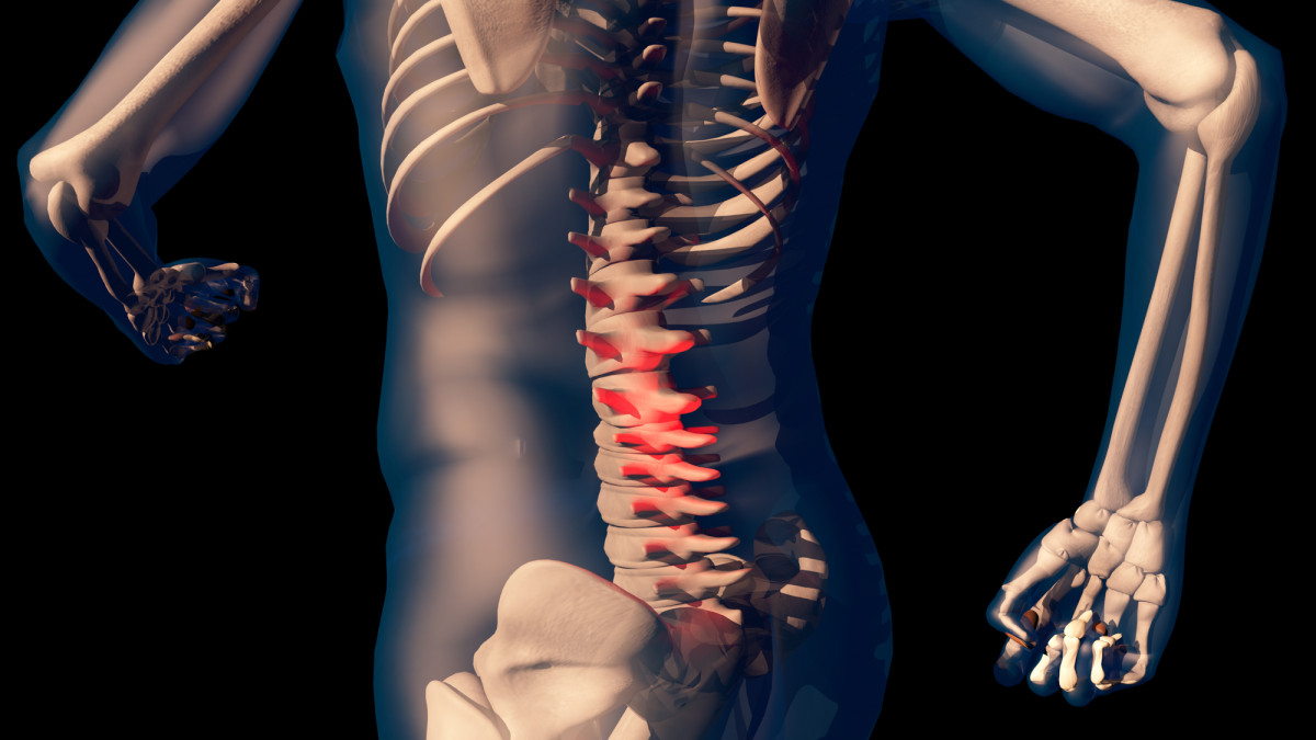 Spinal Fusion Surgery Alternative.jpg