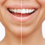 Veneers Nashville .jpeg