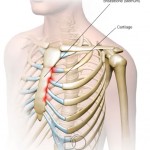 Blog-05 Doctors-of-Osteo-Costochondritis.jpg