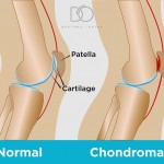 Blog-04 Doctors-of-Osteo-Chondromalacia-Patella.jpg