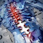 foraminal stenosis.jpg