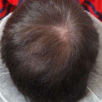 After Scalp Micropigmentation Session With Hair.jpg