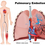 pulmonary-embolism-lawsuits.jpg