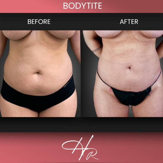 Azure Med Spa: Frisco’s BodyTite Liposuction Experts