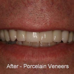 Smile Makeovers From Pinnacle Dental