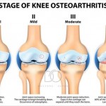 Osteopathy-and-Osteoarthiritis.jpeg