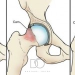 Blog-07__01-Doctors-of-Osteo-FAI-HIP-Pain.jpg