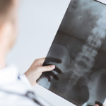 spinal fusion surgery alternatives.jpg