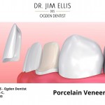 Porcelain Veneers Dr Jim Ellis DDS Ogden Dentist.jpg