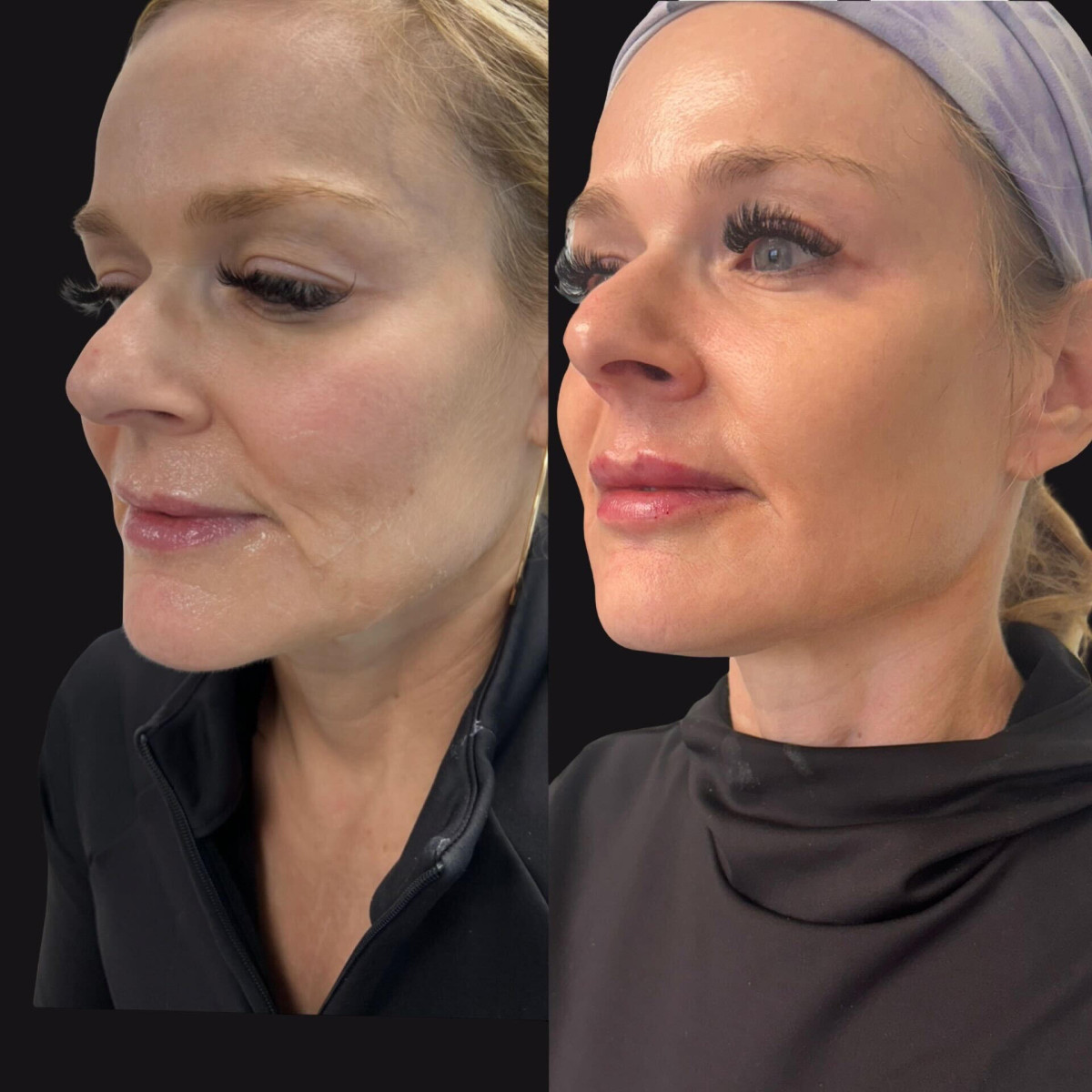 iGlō Aesthetics Expands Sculptra Services in Miami Lakes