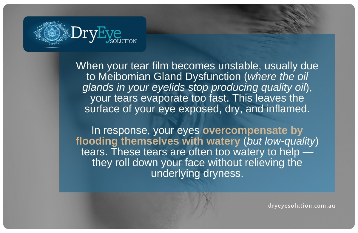 Dry Eye Clinic Double Bay | Your Watery Eyes Might Actually Be Dry Eye Disease