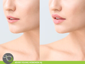 Lip Enhancement Hoboken NJ