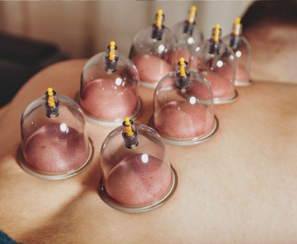 Dynamic Stretch Therapy Explains Clinical Cupping Applications in Honolulu