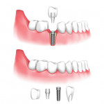 Veneers And Dental Implants