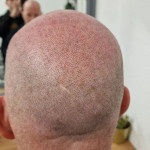Scalp Micropigmentation Example 1.jpg