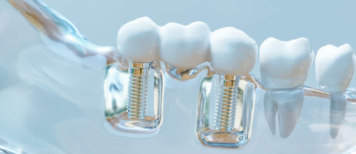 dental implants