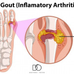 Gout+Inflammatory+Arthritis.jpeg