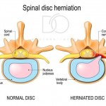 Disc-Herniation.jpeg