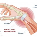 Blog-06 Doctors-of-Osteo-De-Quervains-Tenosynovitis.jpg