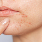 Olympia Aesthetics - Blog photo.png