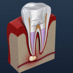 Root Canal