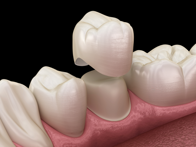 Is It Cheaper to Fix a Cavity or Get a Crown? | Ridgetop Dental