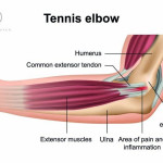 Doctors-of-Osteo-Tennis-Elbow.jpg