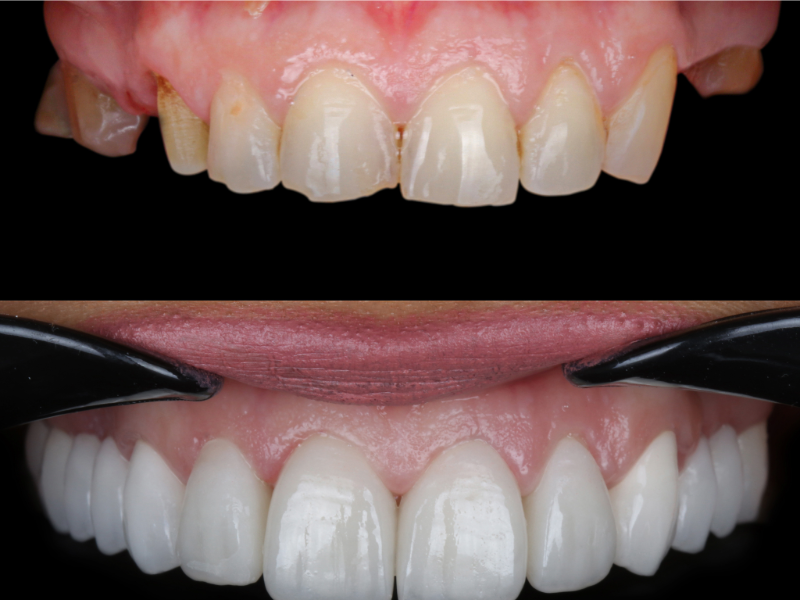 Before and after porcelain veneers showing how cosmetic dental treatment at Ridgetop Dental transformed worn, discolored teeth into a bright, natural-looking smile.