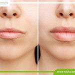 Lip Enhancement Wellington FL 06.jpg