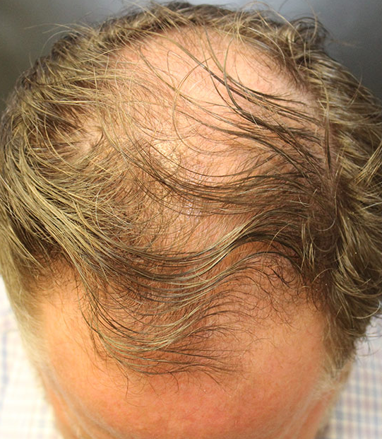 Springs Rejuvenation Miami Pioneers Live Stem Cell Therapy