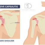 Blog- Frozen Shoulder.jpg