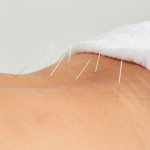 acupuncture treatment for low back pain-omaha nebraska.jpg