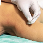 Physiotherapist Wodonga | Pain Relief With Dry Needling