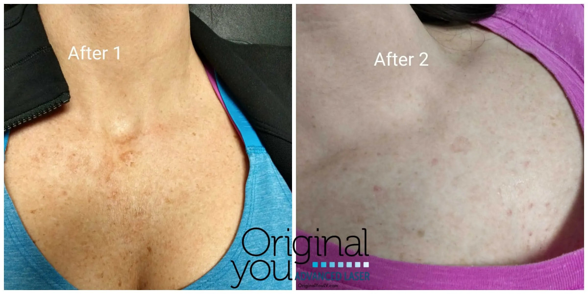 Original You Launches Advanced Pain-Free Laser Tattoo Removal in Las Vegas