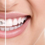 Dentist nashville invisalign .png