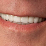 Dental Veneers From Pinnacle Dental in Houston
