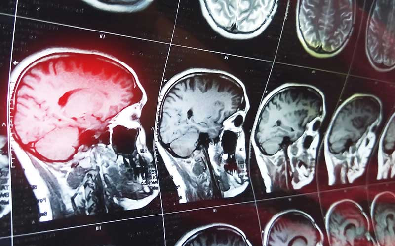 traumatic brain injury and truck accidents