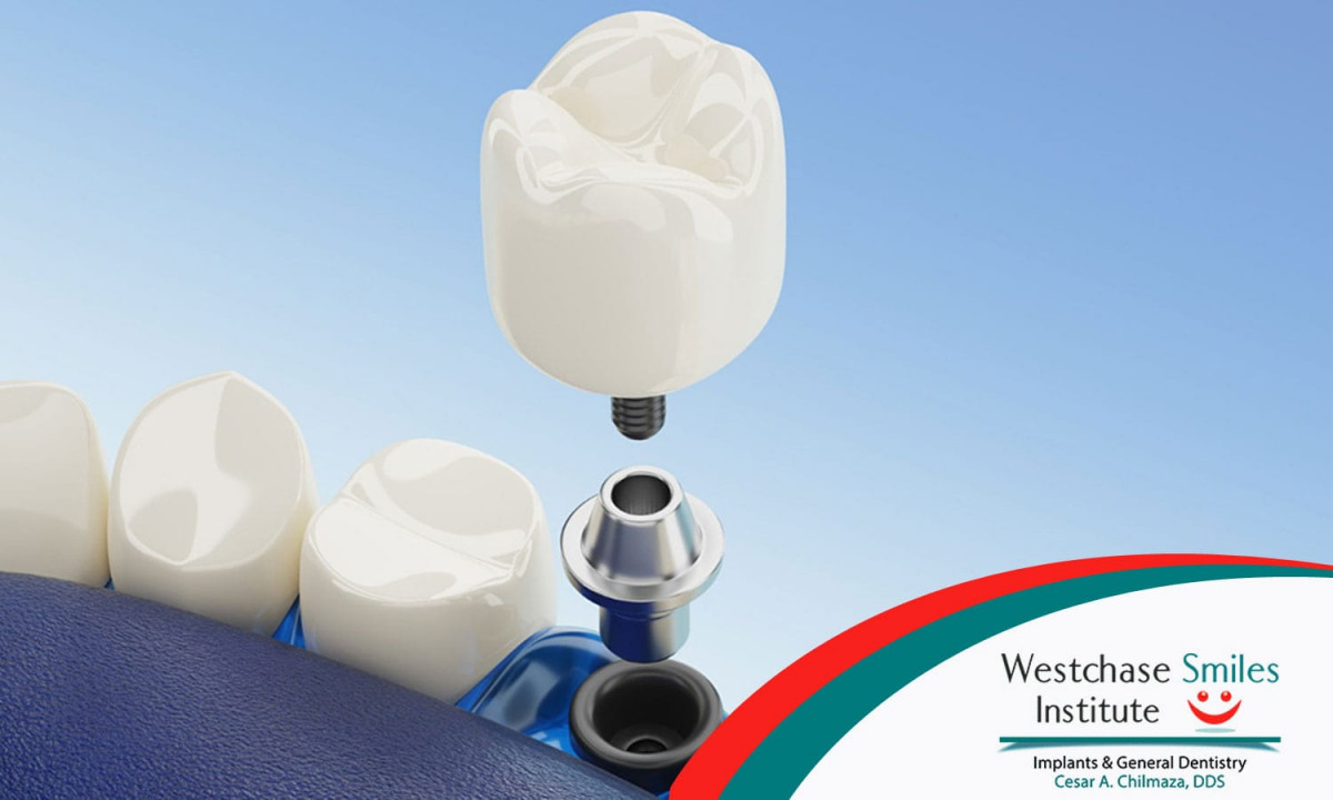 The archive place tampa dentist looks at bone grafting for dental