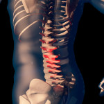 Spinal Fusion Surgery Alternative.jpg