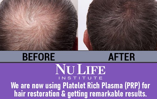 A Remarkable New Hair Loss Treatment In Miami For Thinning Hair River Country News Channel Nebraska