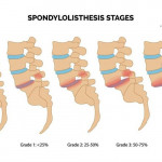 Blog-15__01-Spondylolisthesis.jpg