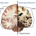 Alzheimers-Brain.jpeg