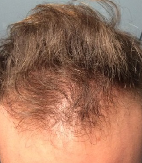 Revolutionary Micro FUE Hair Transplant with Stem 3 Protocol